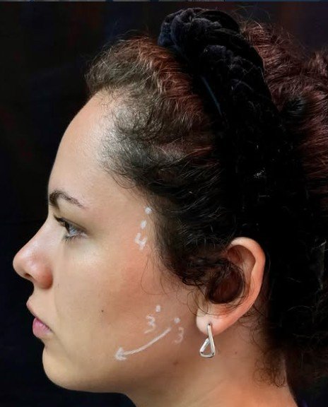 Paciente de perfil com marcações dos pontos musculares da face durante a avaliação